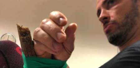 Imágenes sensibles: un ex MotoGP sufrió una fractura impresionante