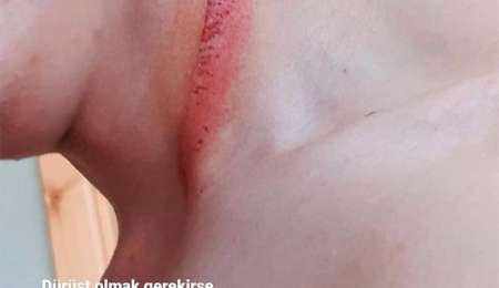 Milagro, el disco de freno de Binder casi le corta el cuello a un rival