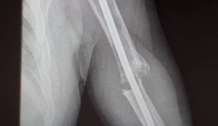 Se quebró en 2016 y no puede trabajar porque no le cubren la operación