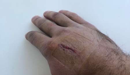 De Benedictis mostró cómo está la mano lastimada