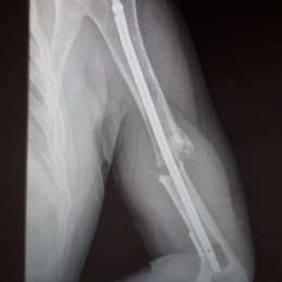 Se quebró en 2016 y no puede trabajar porque no le cubren la operación